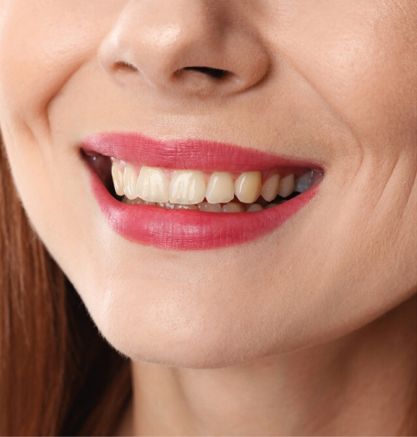 dis-beyazlatma-bleaching-once